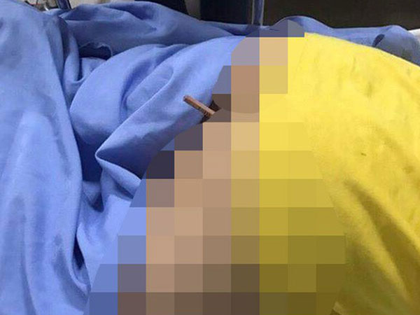 Nam sinh lớp 4 nhập viện vì bị bút chì dài gần 20cm đâm sâu vào mông