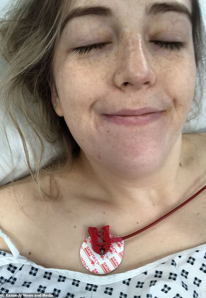 Từ một thói quen mà ai cũng có khiến cô gái 23 tuổi bị đột quỵ tới liệt nửa người