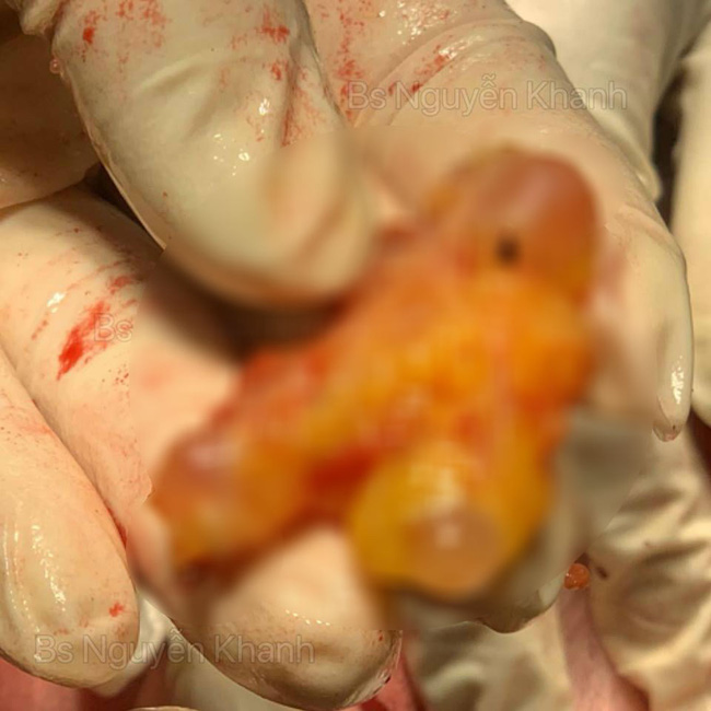 Khiếp vía với khối silicone được lấy ra khỏi ngực sau 8 năm, hội chị em còn giật mình với điều ước của bác sĩ