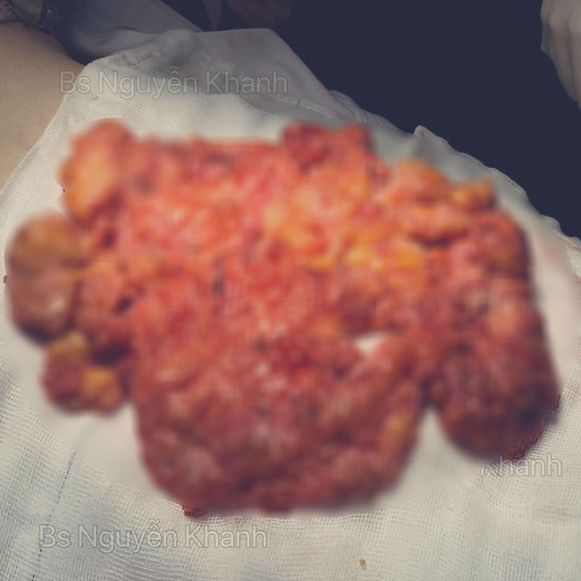 Khiếp vía với khối silicone được lấy ra khỏi ngực sau 8 năm, hội chị em còn giật mình với điều ước của bác sĩ