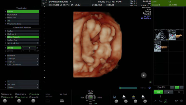 Mẹ 9x và câu chuyện kì tích khi mang thai đôi, bị truyền máu song thai nhưng vẫn chiến đấu để giữ lại được 1 em bé