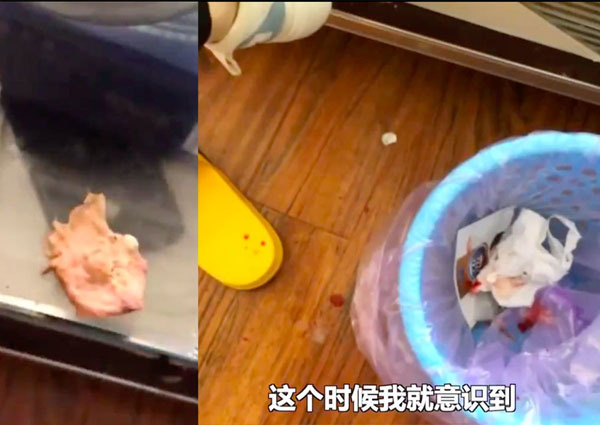 6 tháng sau khi nâng mũi trăm triệu, cô gái trẻ hắt xì ra bông gạc đẫm máu