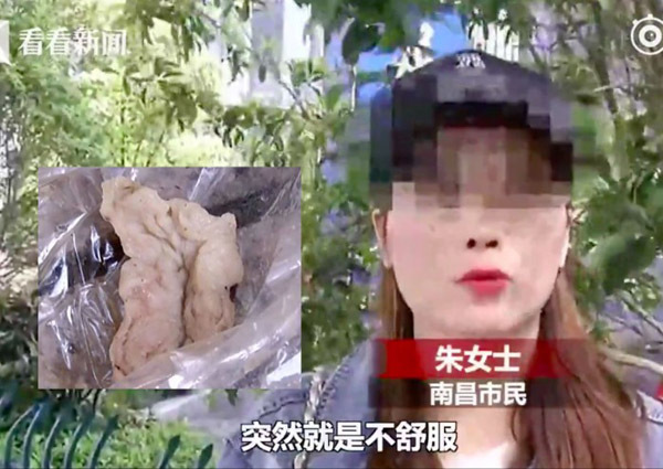 6 tháng sau khi nâng mũi trăm triệu, cô gái trẻ hắt xì ra bông gạc đẫm máu