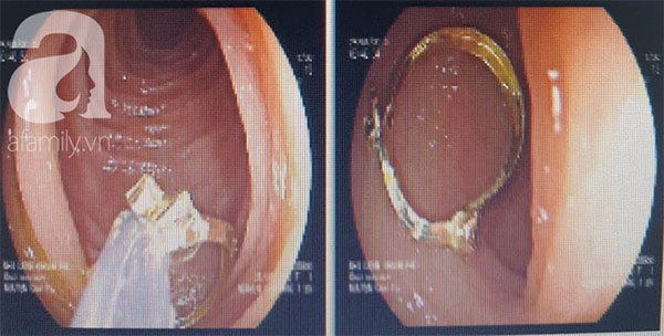 Bé gái 1 tuổi suýt chết vì tổn thương dạ dày vì giật khuyên tai từ bạn và nuốt