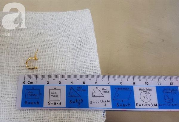 Bé gái 1 tuổi suýt chết vì tổn thương dạ dày vì giật khuyên tai từ bạn và nuốt