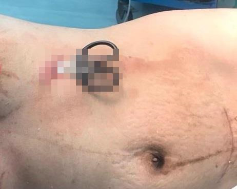 Cứu sống sản phụ tự đâm thấu tim vì trầm cảm