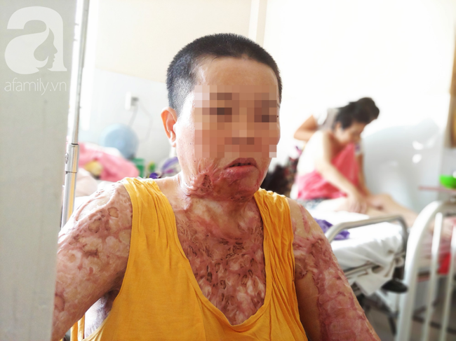 Người phụ nữ bị tình cũ tạt axit bỏng nặng sau khi níu kéo tình cảm không thành