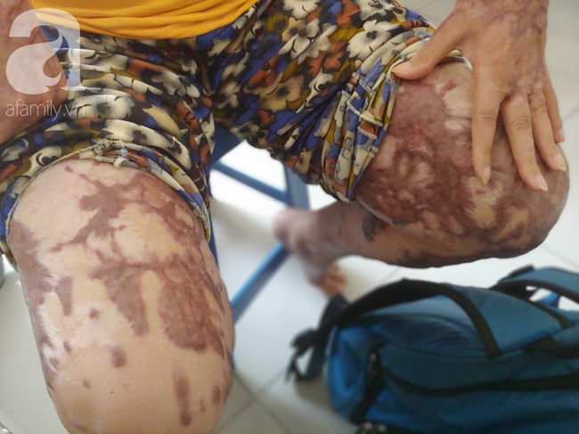 Người phụ nữ bị tình cũ tạt axit bỏng nặng sau khi níu kéo tình cảm không thành