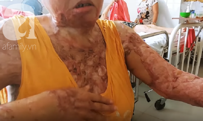 Người phụ nữ bị tình cũ tạt axit bỏng nặng sau khi níu kéo tình cảm không thành