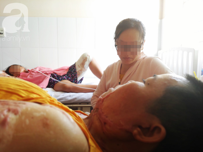 Người phụ nữ bị tình cũ tạt axit bỏng nặng sau khi níu kéo tình cảm không thành