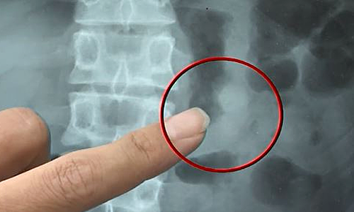 Nuốt nhầm tai nghe AirPods