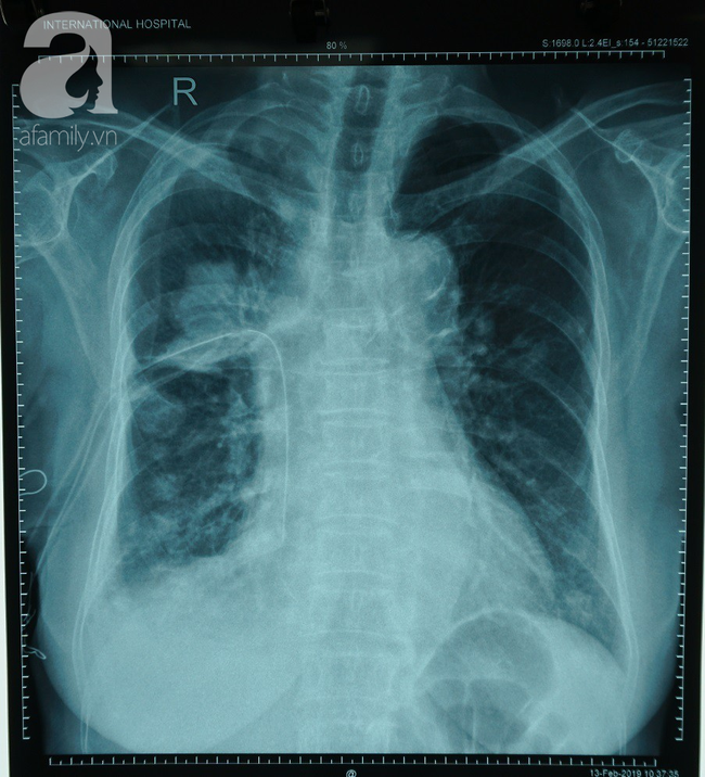 Ngoài thuốc lá thì đây chính là những nguyên nhân không ngờ gây nên bệnh ung thư phổi mà nghệ sĩ Lê Bình phải chống chọi trong thời gian dài