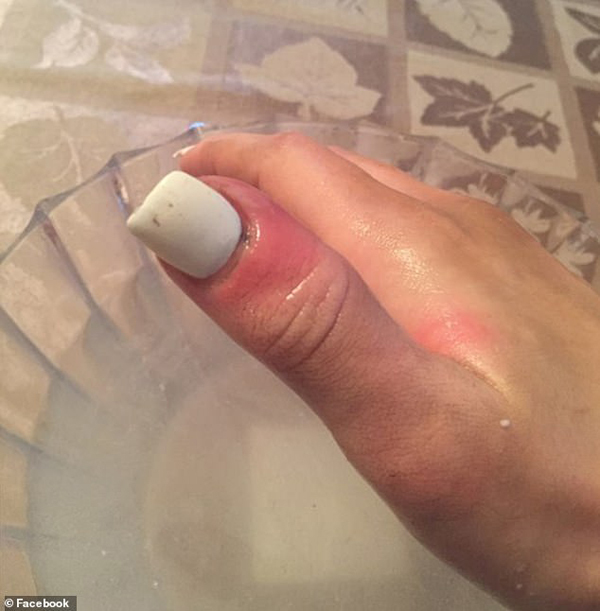 Hoa hậu 21 tuổi phát hiện ung thư nhờ dấu hiệu dễ bị bỏ qua trên ngón tay