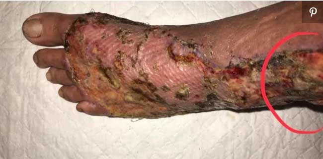 Vi khuẩn ăn thịt người gần như đã lấy mất chân người đàn ông này, những ai đi biển cần chú ý!