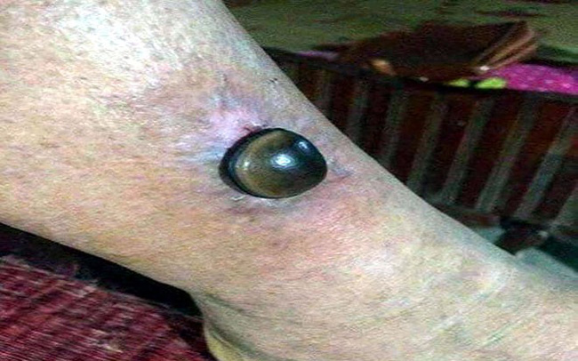 Hạt đậu Lào được dân mạng đồn thổi thần kì, chữa bách bệnh: Sự thật được chuyên gia tiết lộ sẽ khiến bạn ngã ngửa Hạt đậu Lào được dân mạng đồn thổi thần kì, chữa bách bệnh: Sự thật được chuyên gia tiết lộ sẽ khiến bạn ngã ngửa