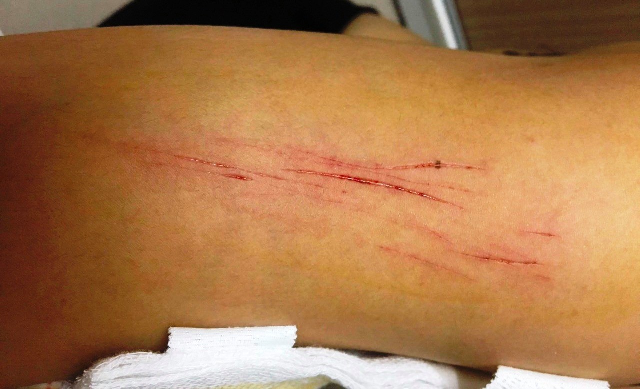 Bị kim tiêm, vật nhọn đâm: để chống phơi nhiễm HIV bạn nhất thiết phải lưu ý những điều sau