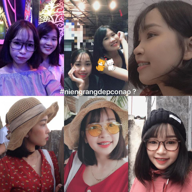 Sau pha niềng răng chấn động MXH, nhiều bạn trẻ không ngại chia sẻ hình ảnh vịt hoá thiên nga với hàm răng của mình