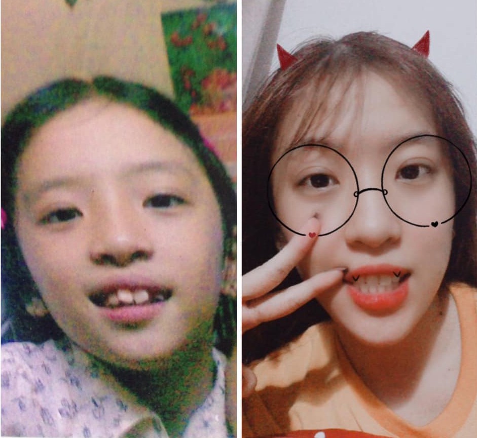 Sau pha niềng răng chấn động MXH, nhiều bạn trẻ không ngại chia sẻ hình ảnh vịt hoá thiên nga với hàm răng của mình