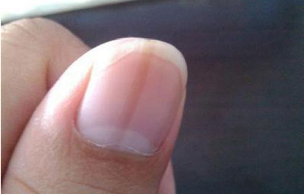 3 bộ phận này trên cơ thể ngày càng đen, báo hiệu gan đang suy yếu 3 bộ phận này trên cơ thể ngày càng đen, báo hiệu gan đang suy yếu