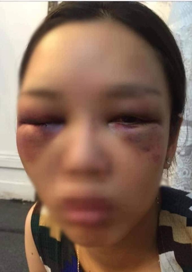 Sự thật bức ảnh cô dâu bị đánh thâm tím mặt mày vì tỏ thái độ lồi lõm, không cho chồng hôn ngay trong đám cưới