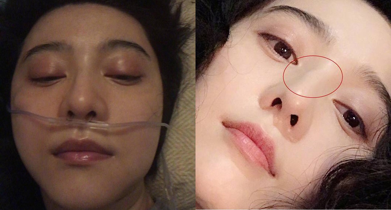 Tự hào là nữ hoàng không động chạm dao kéo, giờ đây Phạm Băng Băng phải sửa mũi để đổi vận sau scandal?