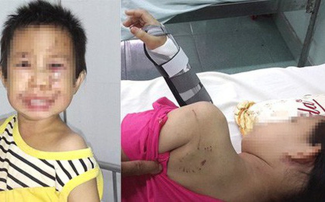 Sang nhà hàng xóm chơi, hai chị em bị chó cắn trọng thương