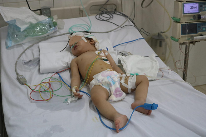 Bé 13 tháng tuổi bị dập não, vỡ xương sọ vì tivi rơi vào đầu
