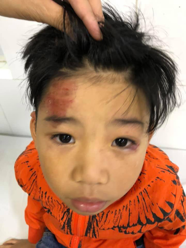 Hai con nhỏ của siêu mẫu Hạ Vy bị xe điên tông chấn thương não rồi bỏ chạy