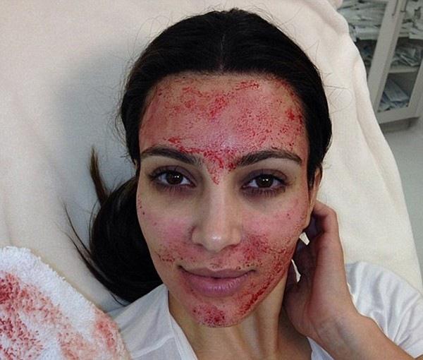 Sững người trước kết quả dương tính với HIV sau thẩm mỹ, đã có 1 trường hợp tại Việt Nam