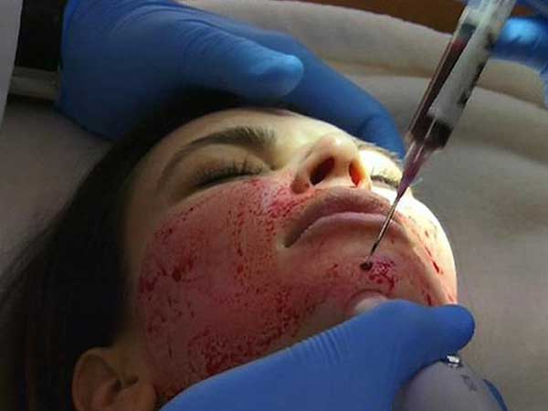 Sững người trước kết quả dương tính với HIV sau thẩm mỹ, đã có 1 trường hợp tại Việt Nam