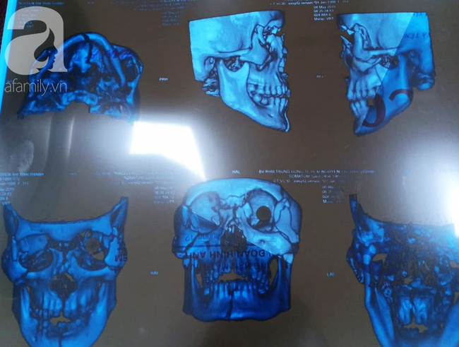 Chở con gái đi thăm ông ngoại bệnh nặng, người mẹ đâm đầu vào trụ đèn, phải bỏ một bên mắt