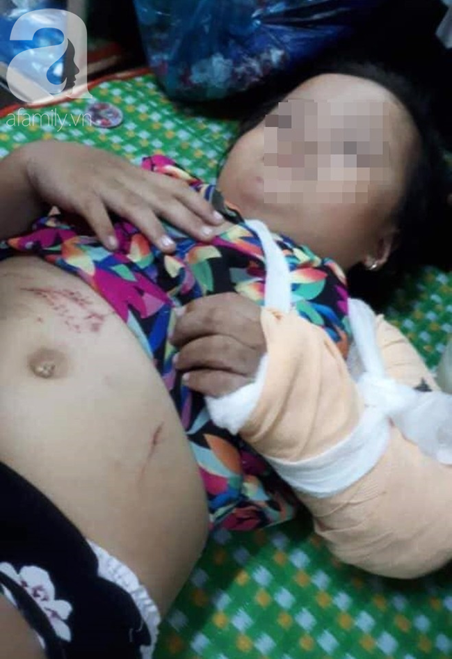 Chở con gái đi thăm ông ngoại bệnh nặng, người mẹ đâm đầu vào trụ đèn, phải bỏ một bên mắt