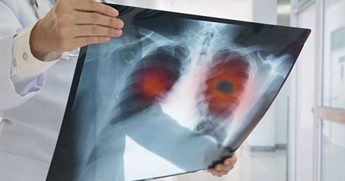 Vì sao không hút thuốc vẫn bị ung thư phổi?