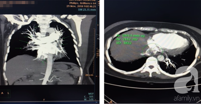 Sản phụ sinh con 4 tháng đã mắc bệnh hiểm, nguy cơ tử vong tới 90%: Cảnh báo căn bệnh đe dọa tính mạng phụ nữ mang thai