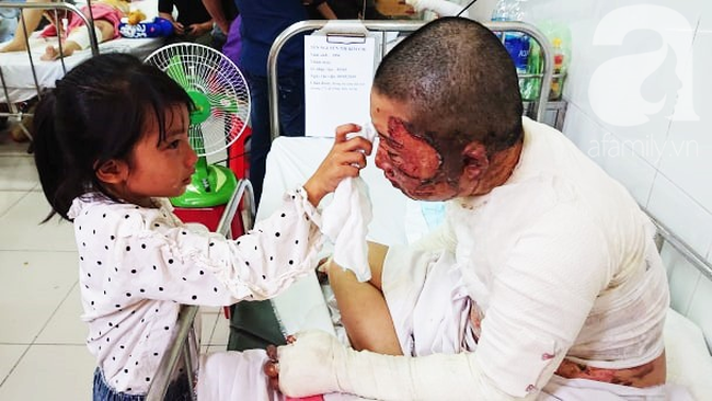 Bố dùng xăng đốt khiến mẹ biến dạng khuôn mặt, con gái 8 tuổi khóc ngất: Mẹ có xấu nhưng con vẫn nhận ra mẹ mà