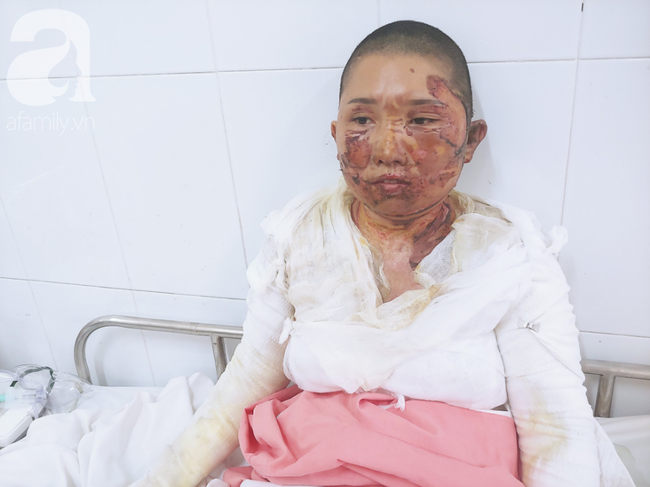 Bố dùng xăng đốt khiến mẹ biến dạng khuôn mặt, con gái 8 tuổi khóc ngất: Mẹ có xấu nhưng con vẫn nhận ra mẹ mà