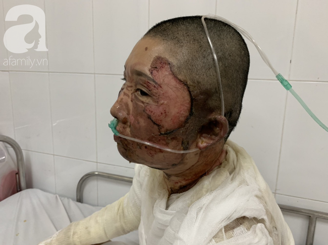 Bố dùng xăng đốt khiến mẹ biến dạng khuôn mặt, con gái 8 tuổi khóc ngất: Mẹ có xấu nhưng con vẫn nhận ra mẹ mà
