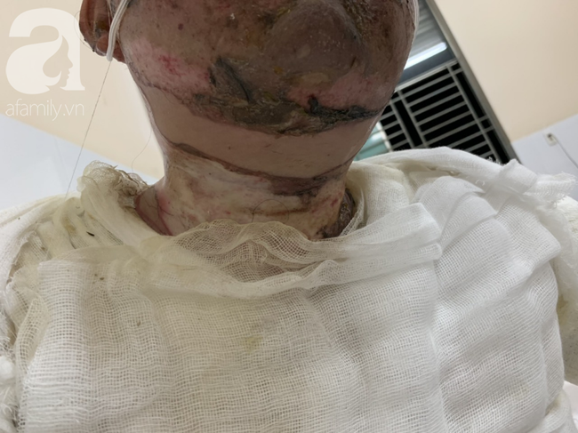 Bố dùng xăng đốt khiến mẹ biến dạng khuôn mặt, con gái 8 tuổi khóc ngất: Mẹ có xấu nhưng con vẫn nhận ra mẹ mà