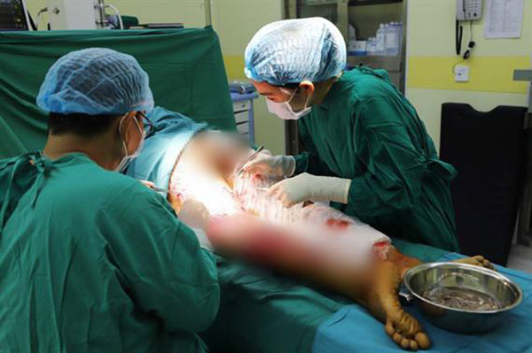 Không để ý vết xước ở tay khi làm thịt lợn, người phụ nữ bị suy đa tạng nghiêm trọng