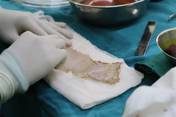 Không để ý vết xước ở tay khi làm thịt lợn, người phụ nữ bị suy đa tạng nghiêm trọng