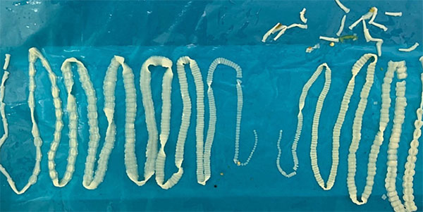 Cặp sán dây dài 2 m chui ra khỏi cơ thể người đàn ông