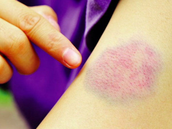 Dấu hiệu nhận biết ung thư máu