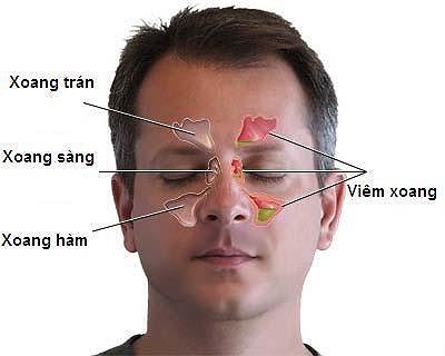Chỉ đau đầu, giảm thị lực, đi khám đã phát hiện ung thư Chỉ đau đầu, giảm thị lực, đi khám đã phát hiện ung thư