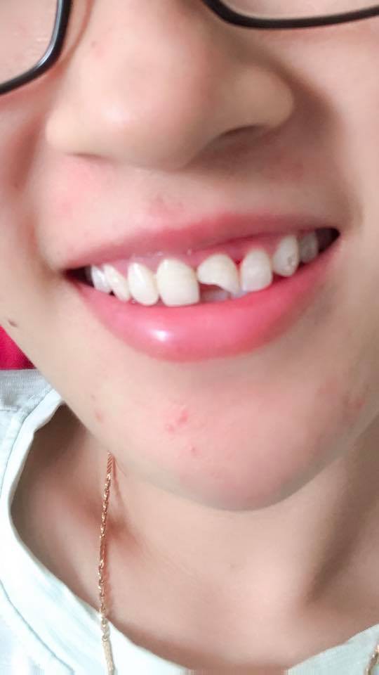 Dở cười dở mếu với sự cố bất ngờ trước đám cưới, ngày trọng đại nhất mà cô dâu lại có hàm răng thế kia...