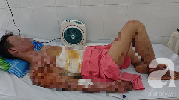 Thương tâm: Chuẩn bị ăn cơm thì nổ bình gas, cả gia đình 4 người bỏng nặng