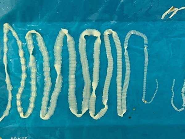 Kinh hãi hai con sán dây dài cả mét trong người một bệnh nhân