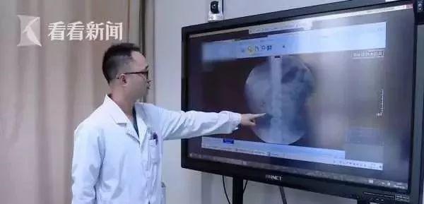 Bé trai 9 tuổi có 56 viên sỏi trong thận vì thói quen ăn thịt mỗi ngày