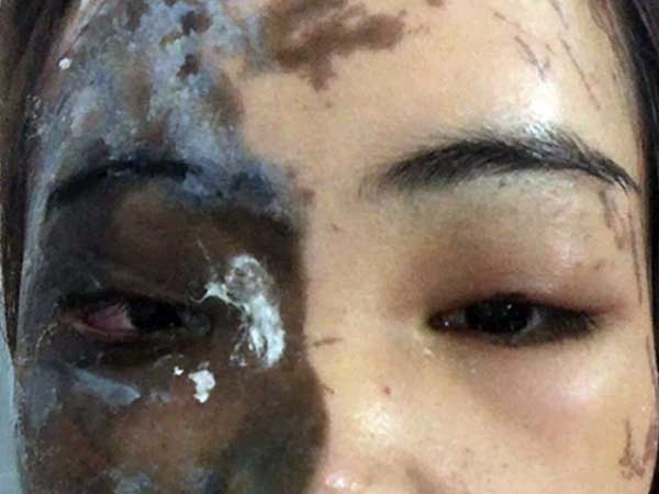 Thiếu uý công an tạt axit vợ sắp cưới vì ghen