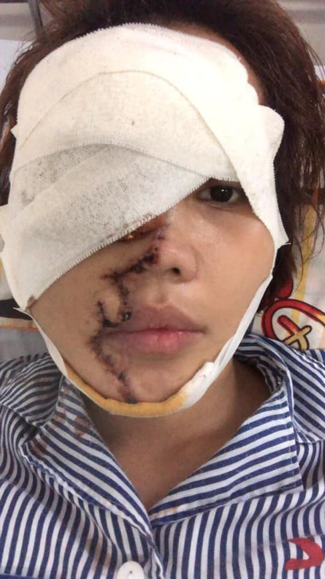 Bố của cô gái bị chồng sắp cưới tạt axit biến dạng gương mặt: Nó làm thế còn đau đớn hơn giết người