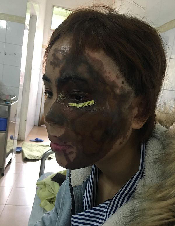 Bác sĩ kể lại hành trình hồi sinh gương mặt xinh đẹp cho cô gái bị thiếu úy tạt axit